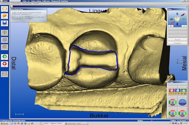 cerec-1