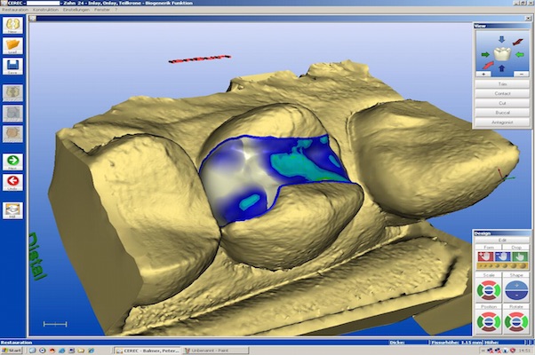 cerec-3